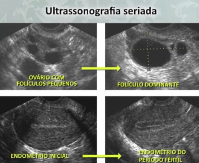 Ooforite ou ovarite: tratamento e reprodução assistida